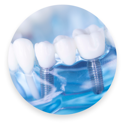 All-On-Four Dental Implants in Chantilly, VA