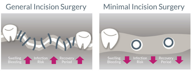 General-Incision vs. Minimal-Incision Surgery