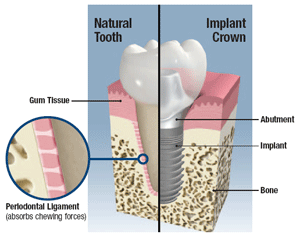 Dental implant