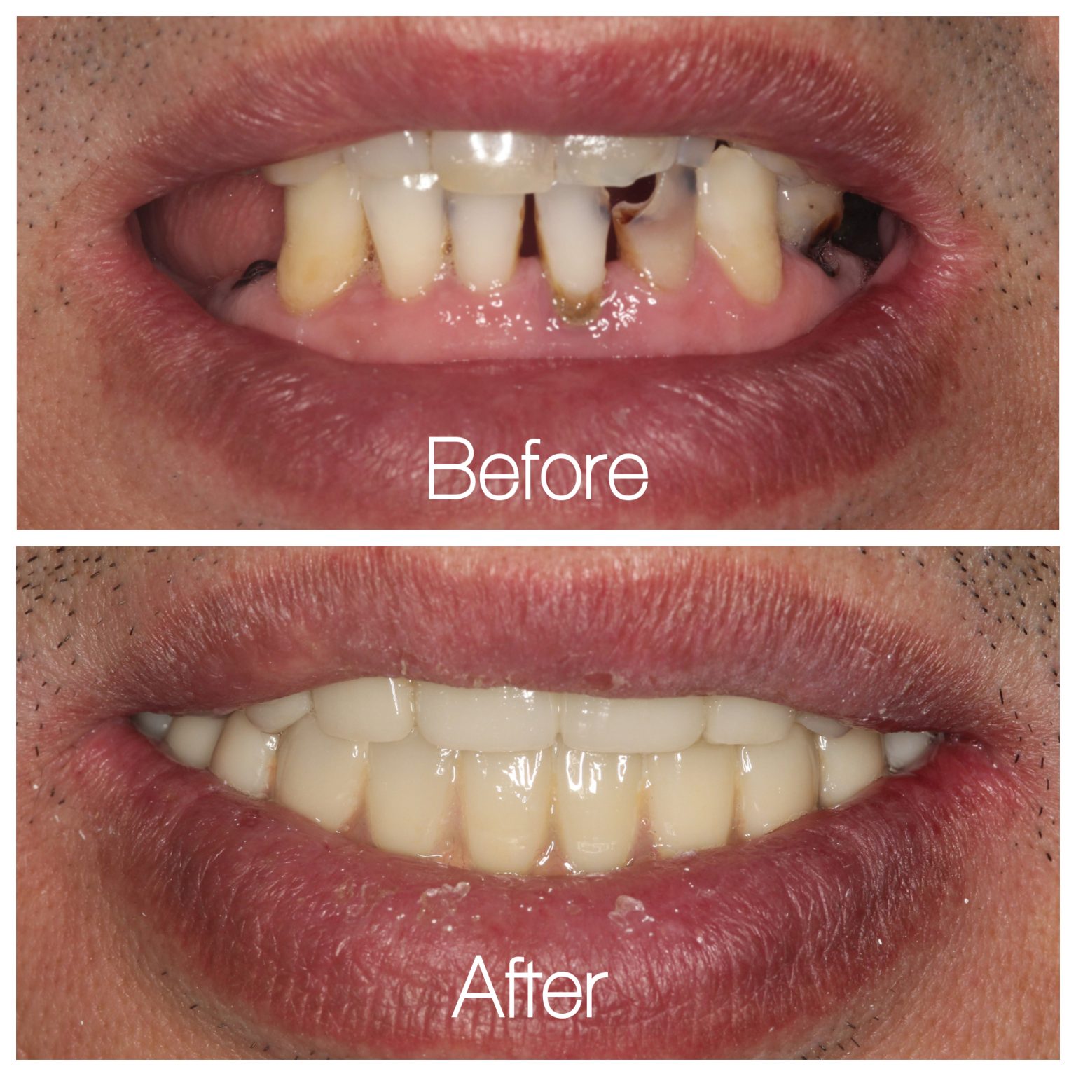 Before and After: Successful full mouth implants/restoration! | Dental